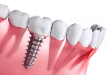 علت تفاوت قیمت در ایمپلنت دندان