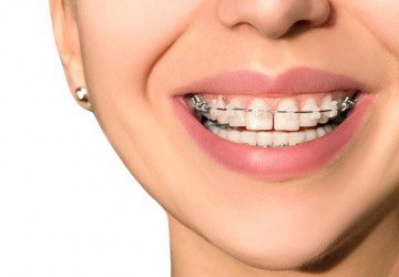 آیا میتوان دندان روکش شده را ارتودنسی کرد؟