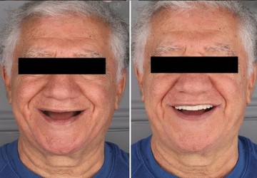 مراحل مراقبت و انجام ایمپلنت دندان