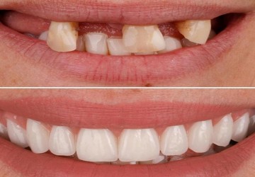 در چه مواردی از ایمپلنت کاشت دندان استفاده می شود؟