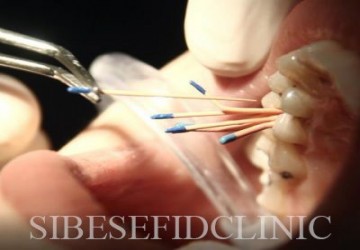 چه موقع به انجام عصب کشی نیاز پیدا خواهیم کرد؟