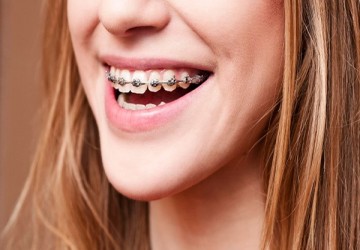 درمان ارتودنسی به همراه ایمپلنت