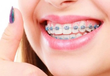 آیا بدون ارتودنسی میتوان دندان ها را مرتب کرد؟