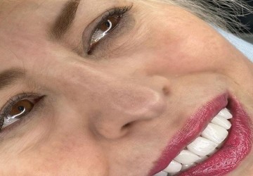 انتخاب رنگ در لمینت کردن دندان