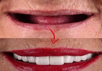 آیا میتوان چند سال بعد از کشیدن دندان ایمپلنت انجام داد؟