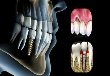 حداکثر طول عمر ایمپلنت دندان چقدر است؟