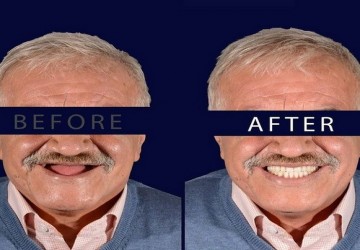 پیوند استخوان در ایمپلنت چه زمانی و به چه منظور انجام می شود؟⁣