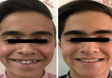 مدت زمان درمان ارتودنسی