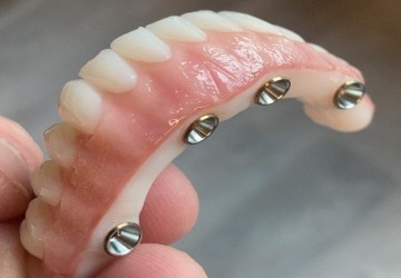 ایمپلنت نکردن چه عوارضی دارد؟