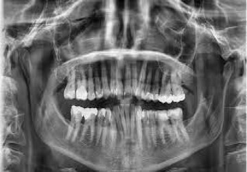 عکس OPG چیست؟همه چیز درباره رادیوگرافیOPG