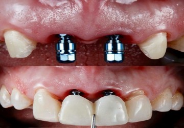 مراقبت های بعد از عمل جراحی ایمپلنت