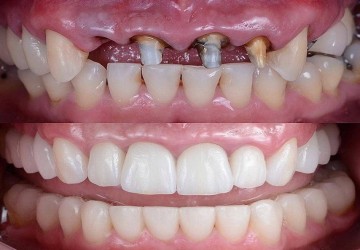 معرفی درمان ریشه یا روت کانال تراپی‌