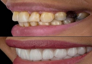 چرا باید ایمپلنت دندان را انجام داد؟