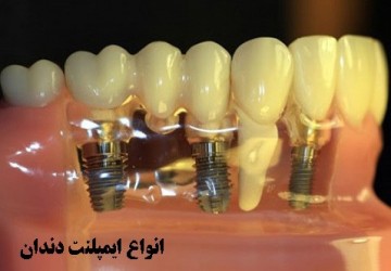 فرآیند جراحی و کاشت ایمپلنت دندان‌ها به چه صورت است؟