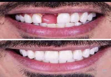 مراقبت‌های بعد از عمل جراحی ایمپلنت