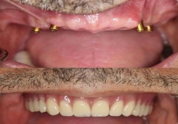 جایگزین دندان از دست رفته