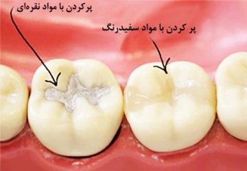 مراقبت های پس از پرکردن دندان