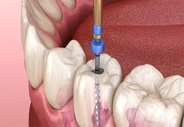 علت تفاوت قیمت در عصب کشی دندان