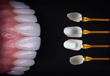 آیا لمینت سرامیکی دائمی است؟