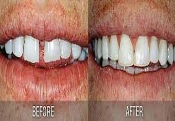 بستن فاصله بین دندان با کامپوزیت یا لمینت