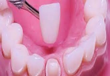 تفاوت روکش و لمینت