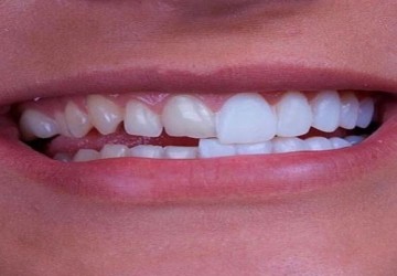 لمینت بدون تراش ممکن است؟