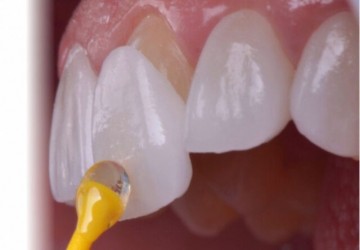آیا لمینت دندان دائمی است؟