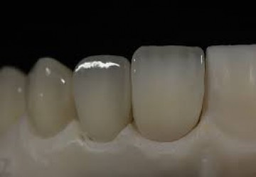 کامپوزیت روی دندان روکش شده