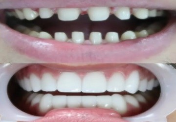 آیا برای کامپوزیت دندان را می تراشند؟