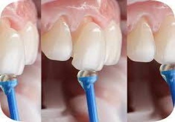 آیا لمینت سرامیکی دندان دائمی است؟