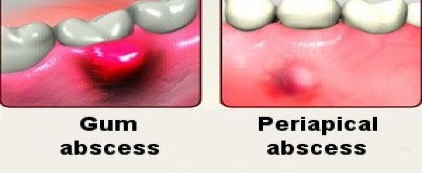 آبسه دندان، علل، علائم و راه درمان آن