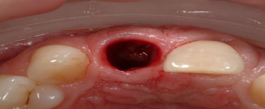 حفره خشک دندان، علائم و درمان حفره خشک