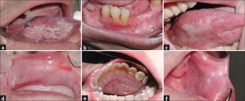 بیماری لوکوپلاکیا (Leukoplakia) چیست؟