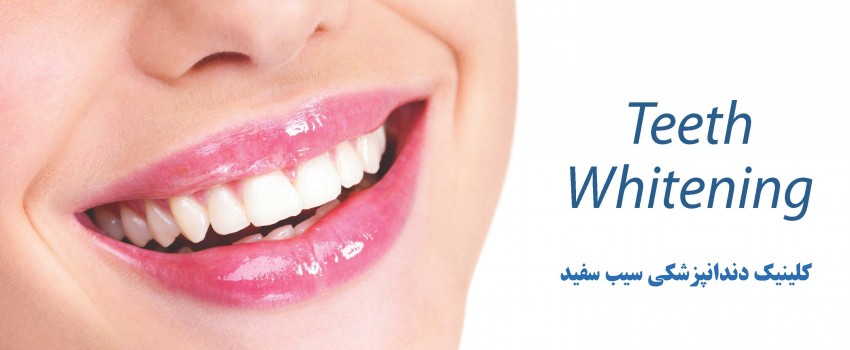 سوالات متداول سفید کردن دندان، راهنمای سفید کردن دندان