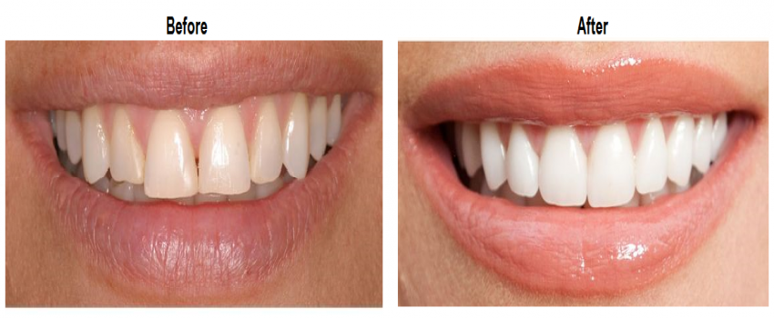 تاثیر لمینت روی زیبایی چهره