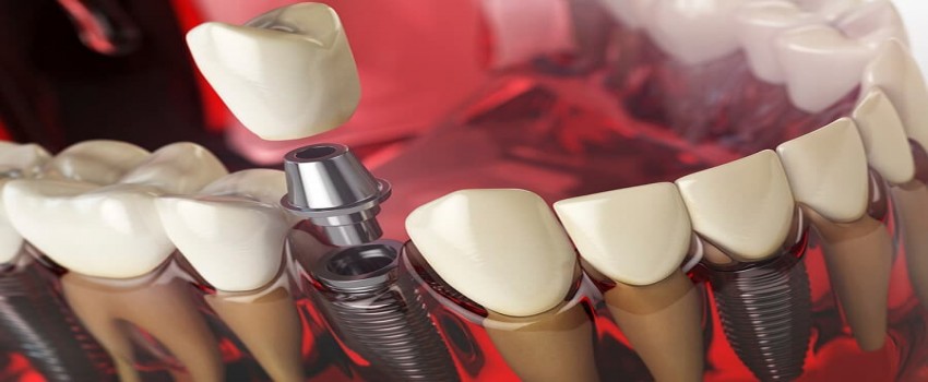 مشکلات ایمپلنت دندان