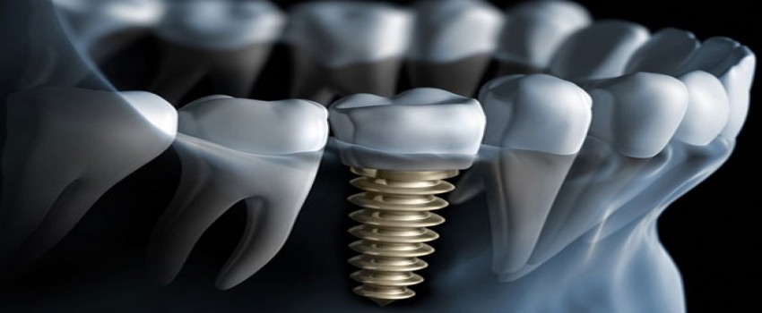 ایمپلنت فوری برای یک لبه ی ضعیف