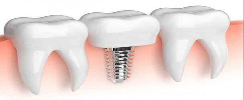 ایمپلنت های کوتاه: جایگزین مناسبی برای تقویت حفره (سینوس)