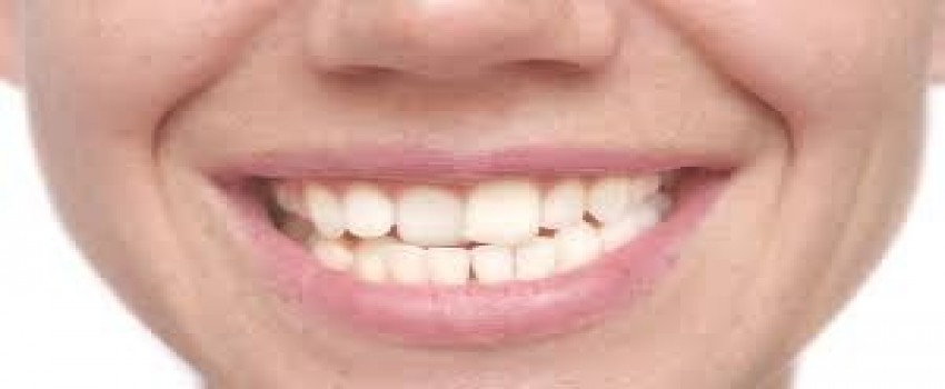 لمینت دندان برای دندان های کج