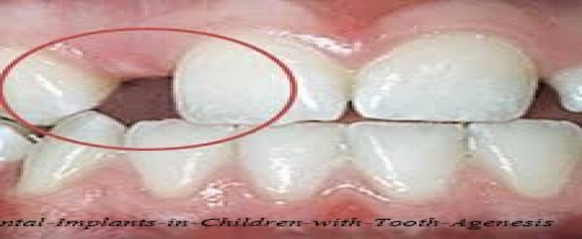 ایمپلنت دندان برای کودکان مبتلا به فقدان مادرزادی دندان
