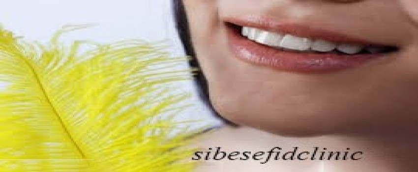لمینت دندان ناموفق