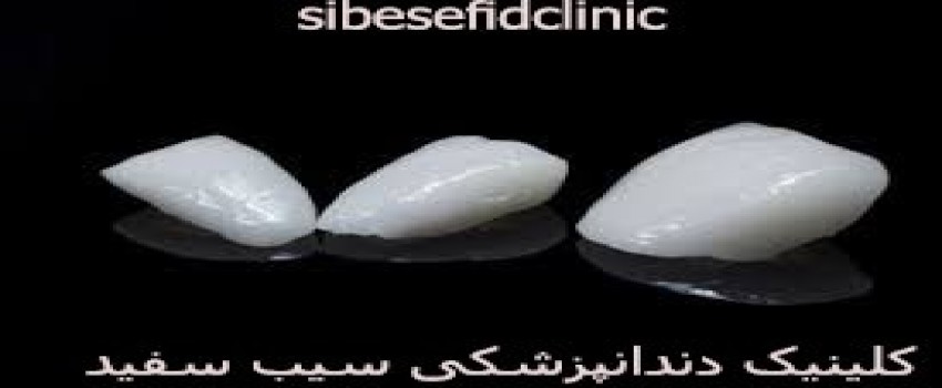 تفاوت لمینت دندان و لومینیرز