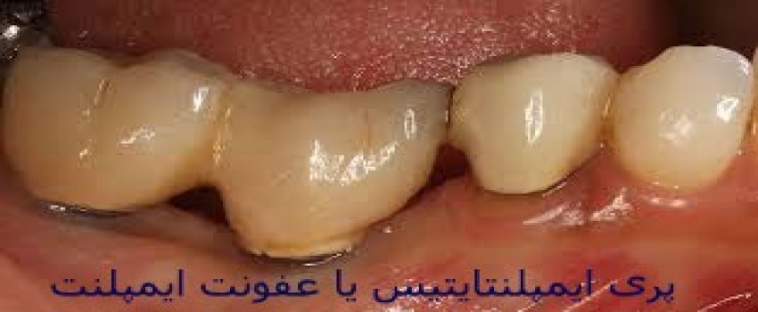 عوارض و خطرات ایمپلنت دندان