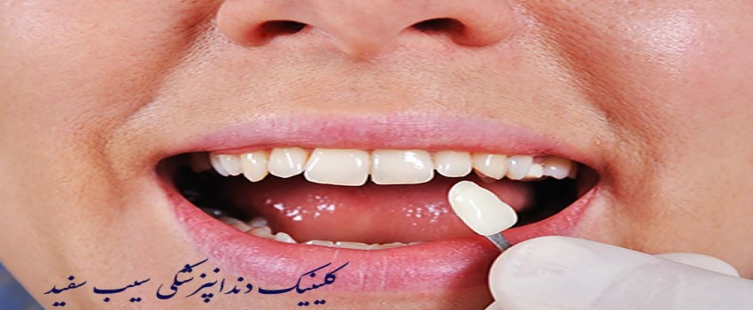 لمینت دندان برای دندان های کوتاه