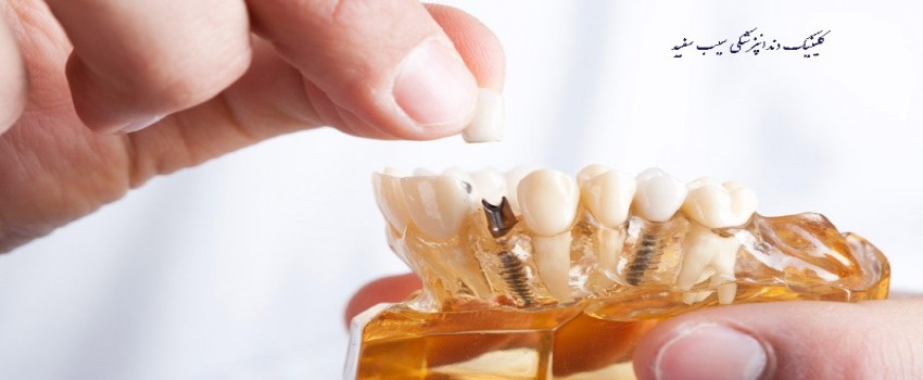 ایمپلنت دندان در یک روز