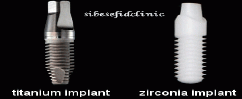 ایمپلنت تیتانیوم بهتر است یا ایمپلنت زیرکونیا