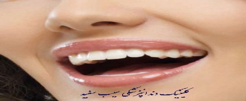 تغییر رنگ لمینت دندان