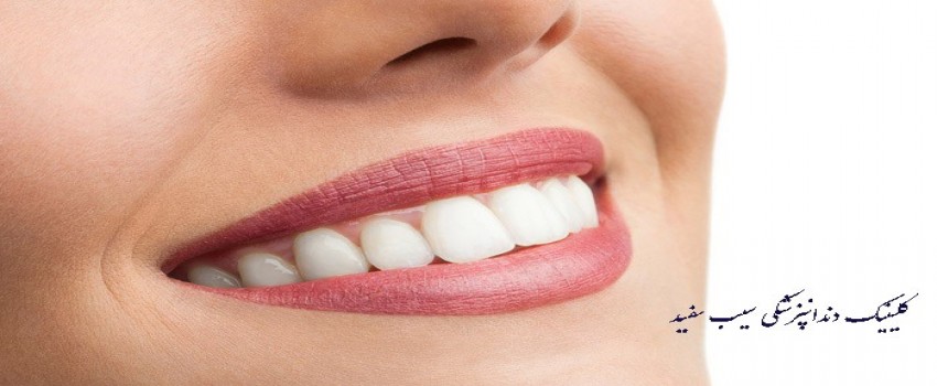 لمینت دندان برای دندان های پوسیده