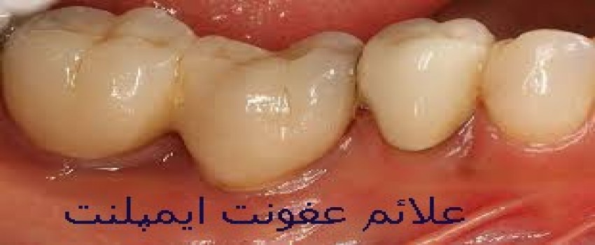 علائم عفونت ایمپلنت دندان