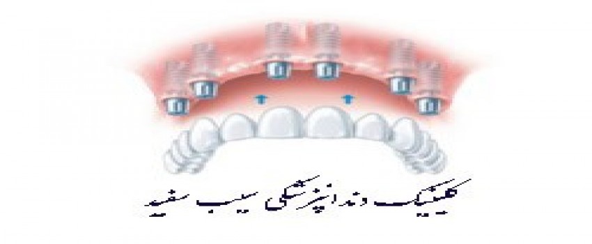 ایمپلنت کل دهان